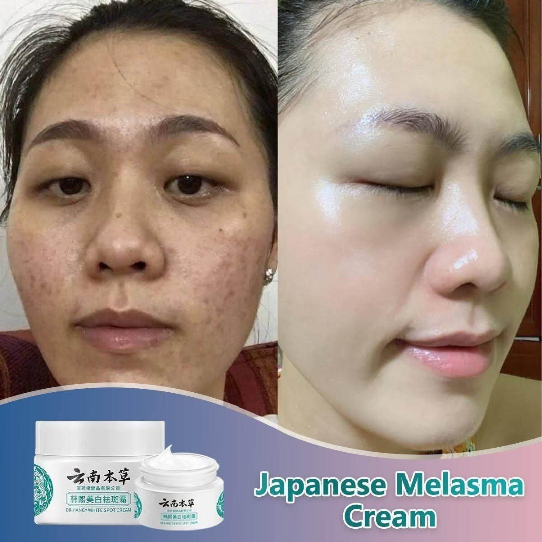 Japanese Melasma Cream, JP.HANCY Yunnan Herbal Freckle-Removing Cream, Hancy Melasma Cream, HANCY Yunnan Herbal Cream, HANCY Cream