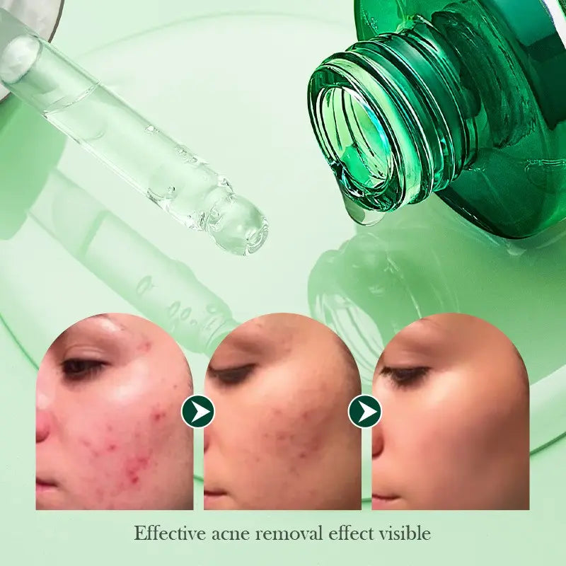 Sadoer Tea Tree Oil Control Anti-Acne Serum Essence 30ml