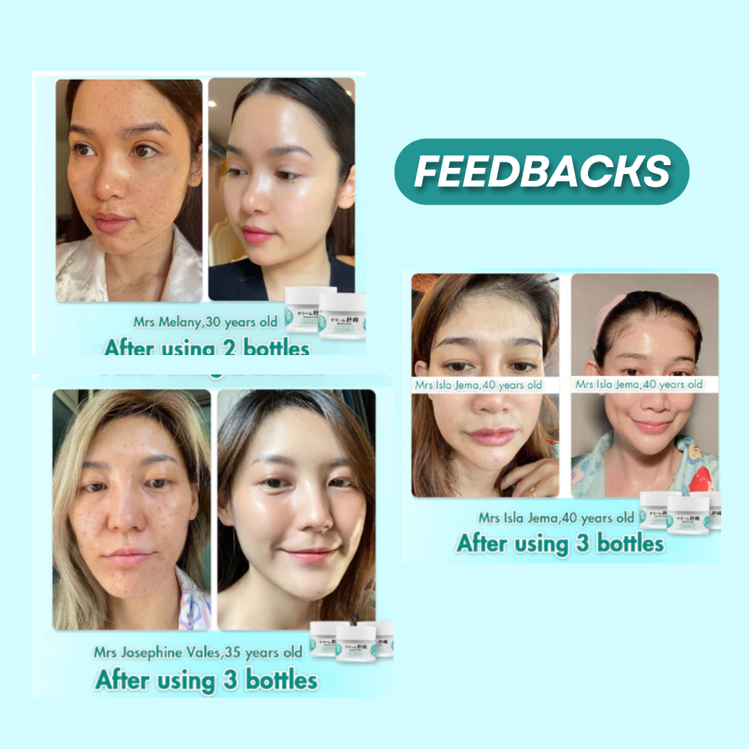 Japanese Melasma Cream, JP.HANCY Yunnan Herbal Freckle-Removing Cream, Hancy Melasma Cream, HANCY Yunnan Herbal Cream, HANCY Cream