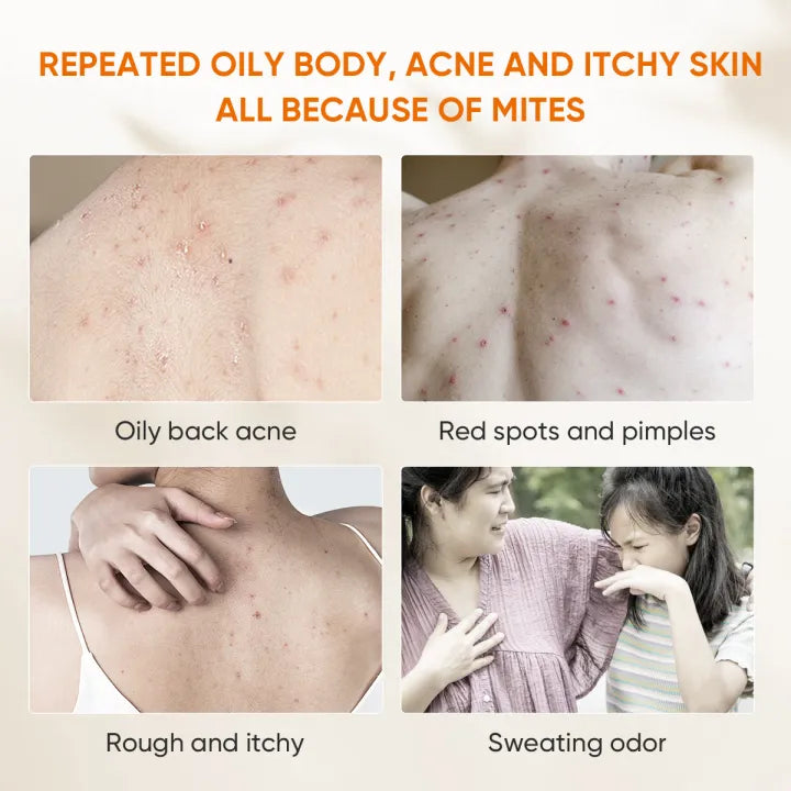 QUARXERY Body Wash Anti Acne Mite Depth Cleaning Skin And Reduce Mite Skin Antibacterial Cleaning Shower Gel